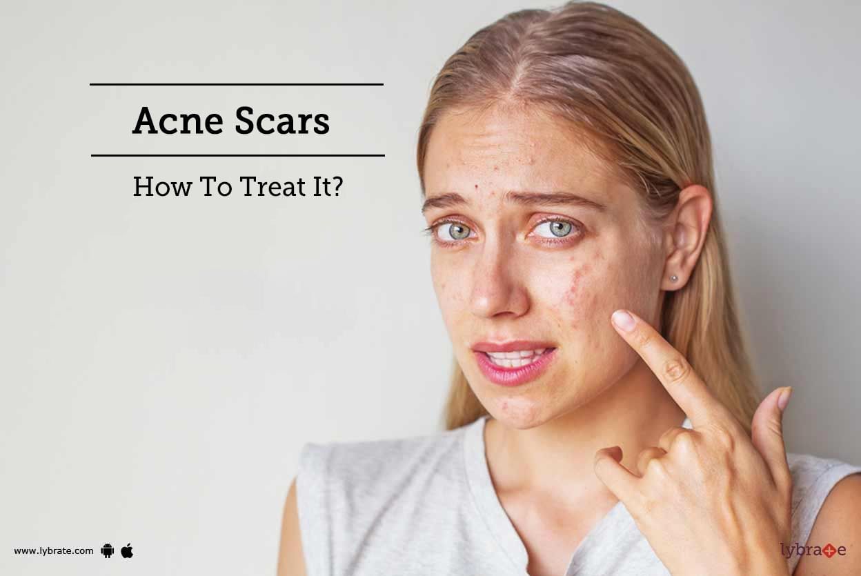 Acne Scars - How To Treat It?