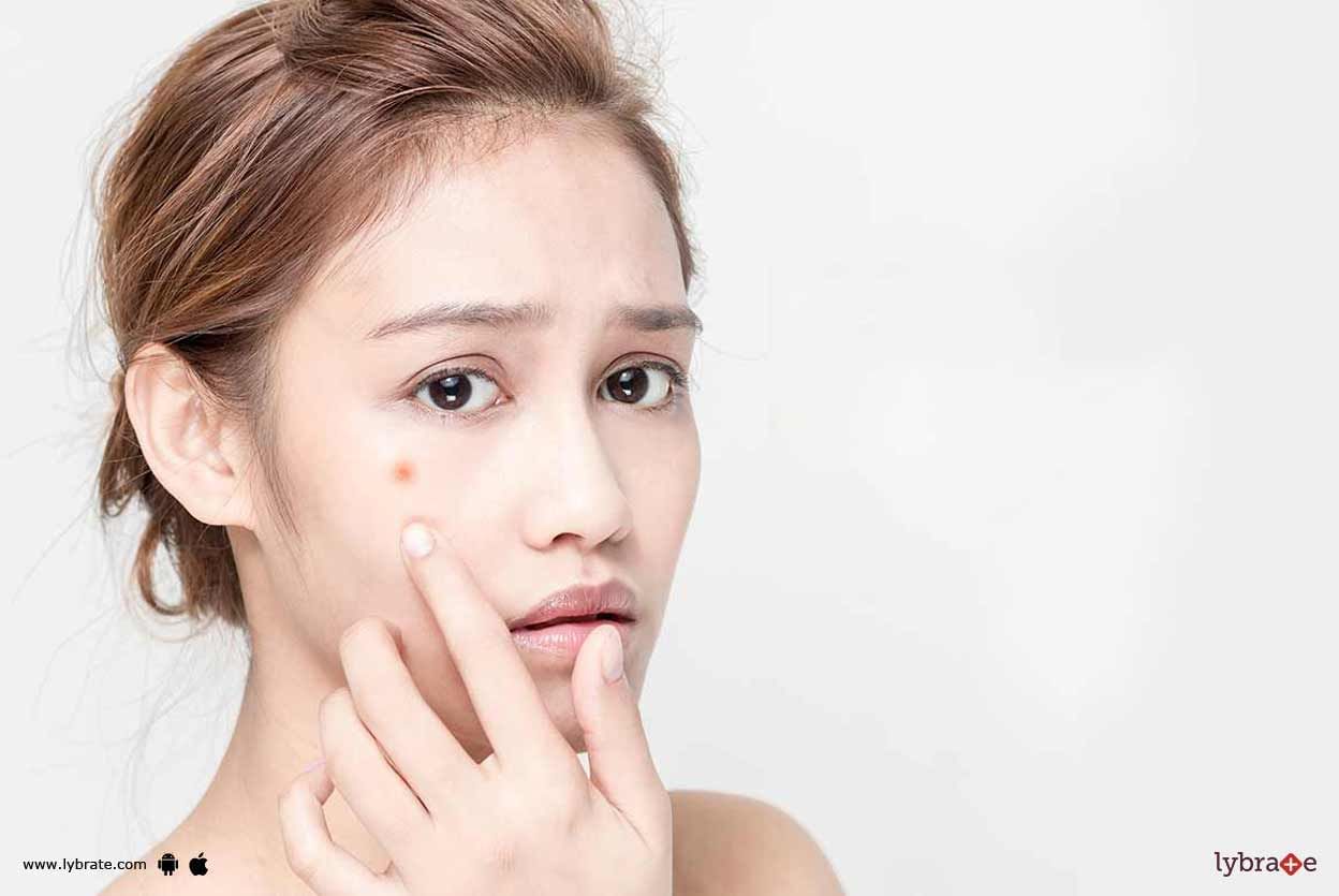How To Get Rid Of Pimples Overnight?