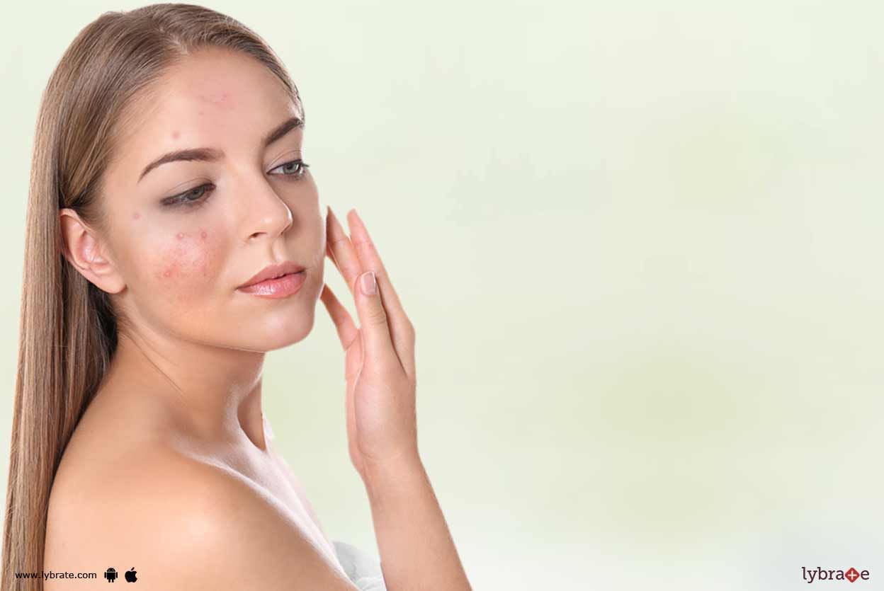 Acne - Treat It With Homeopathy!
