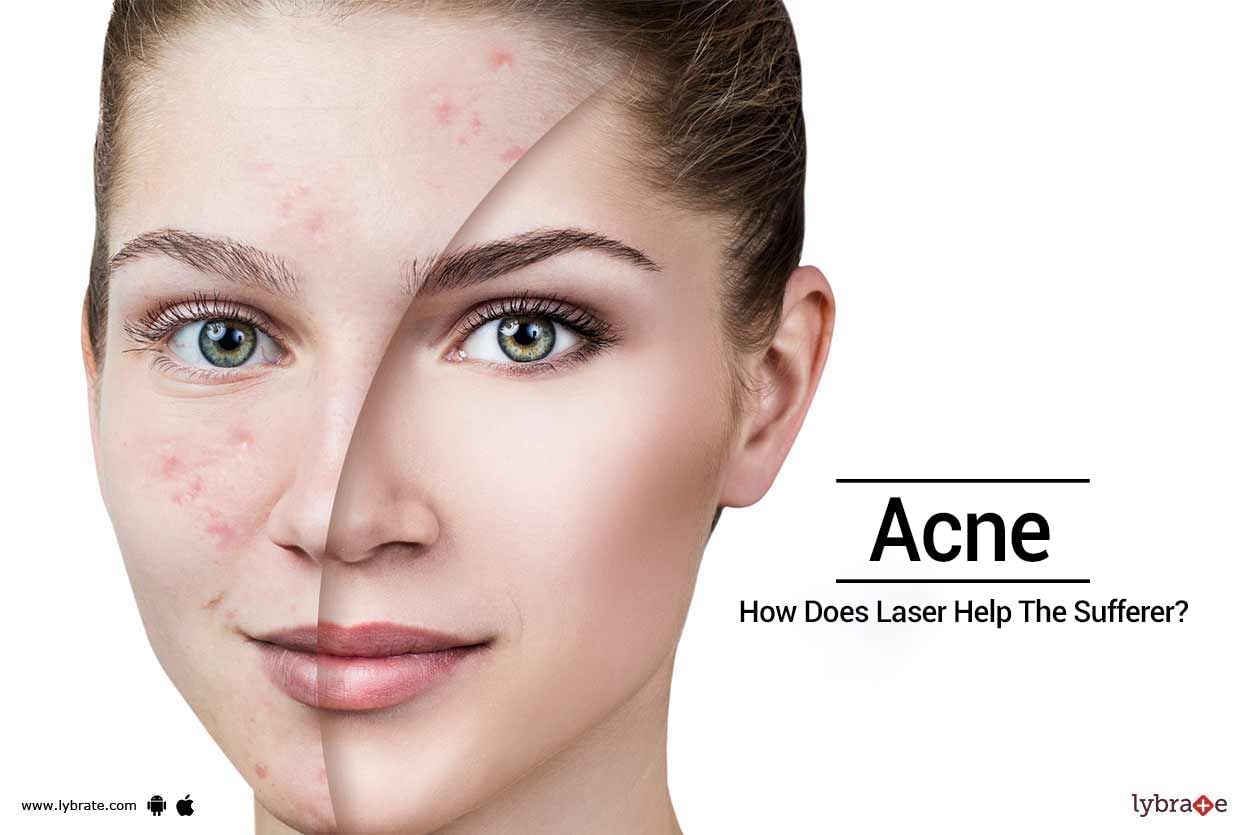 Acne - How Does Laser Help The Sufferer?