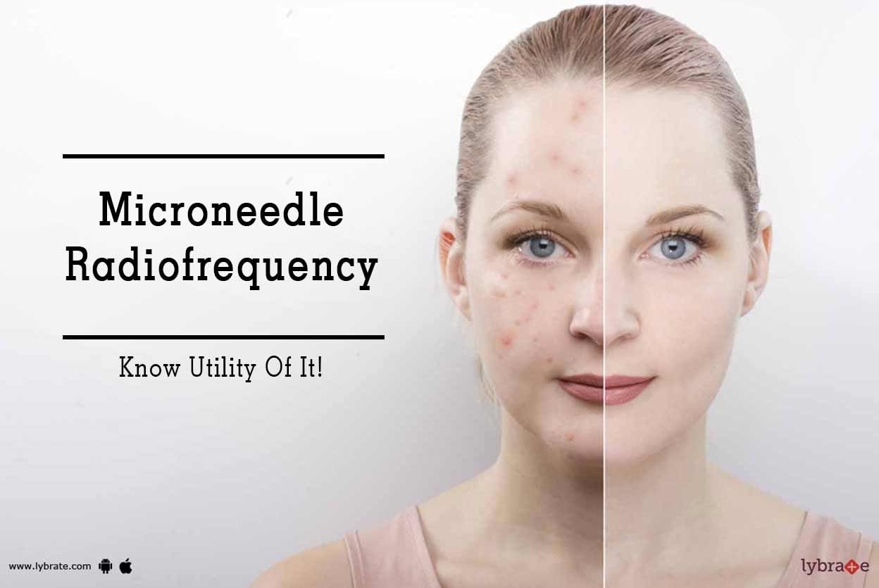 Microneedle Radiofrequency - Know Utility Of It!