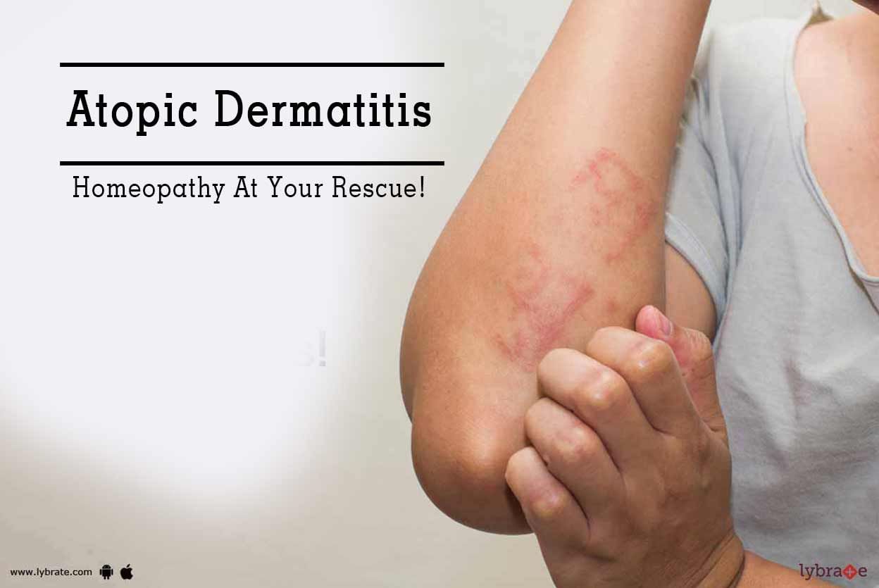 Atopic Dermatitis - Homeopathy At Your Rescue!
