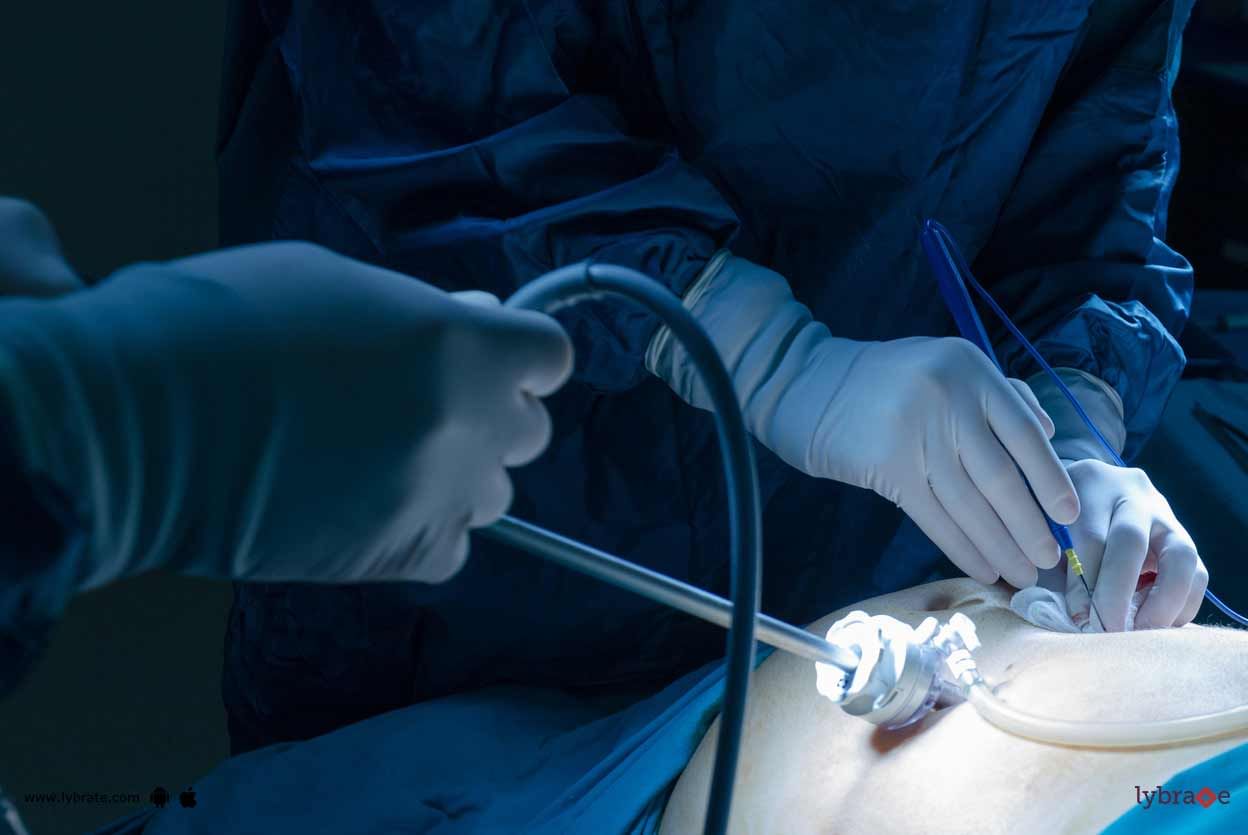Laparoscopic Surgery - Know Complications In It!