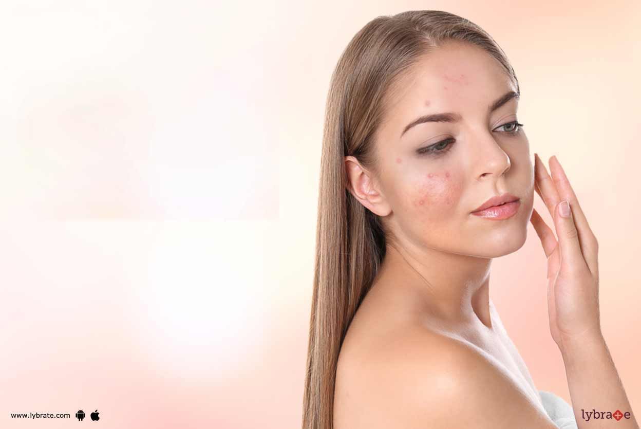 Acne Scars - How To Handle Them Effectively?