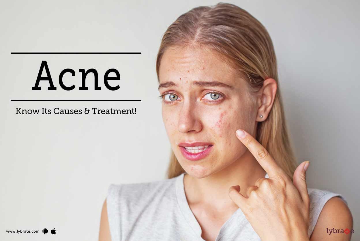 Acne: Know Its Causes & Treatment!