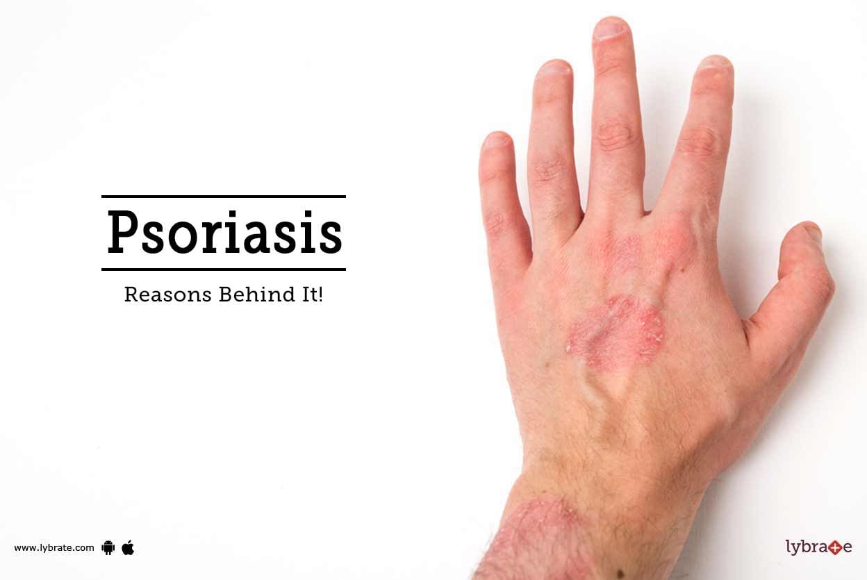 Psoriasis - Reasons Behind It!