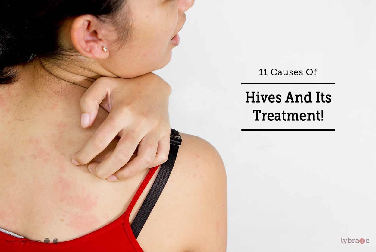 11 Causes Of Hives And Its Treatment!