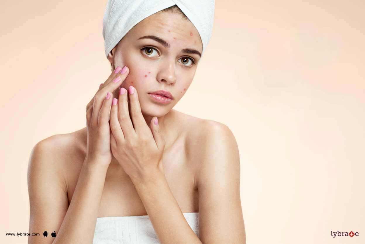 Acne & Breakouts - Skin Care & Ways To Prevent Them!