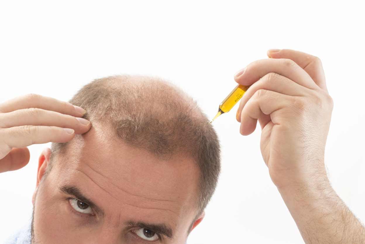 What Makes You A Good Candidate For A Hair Transplant?