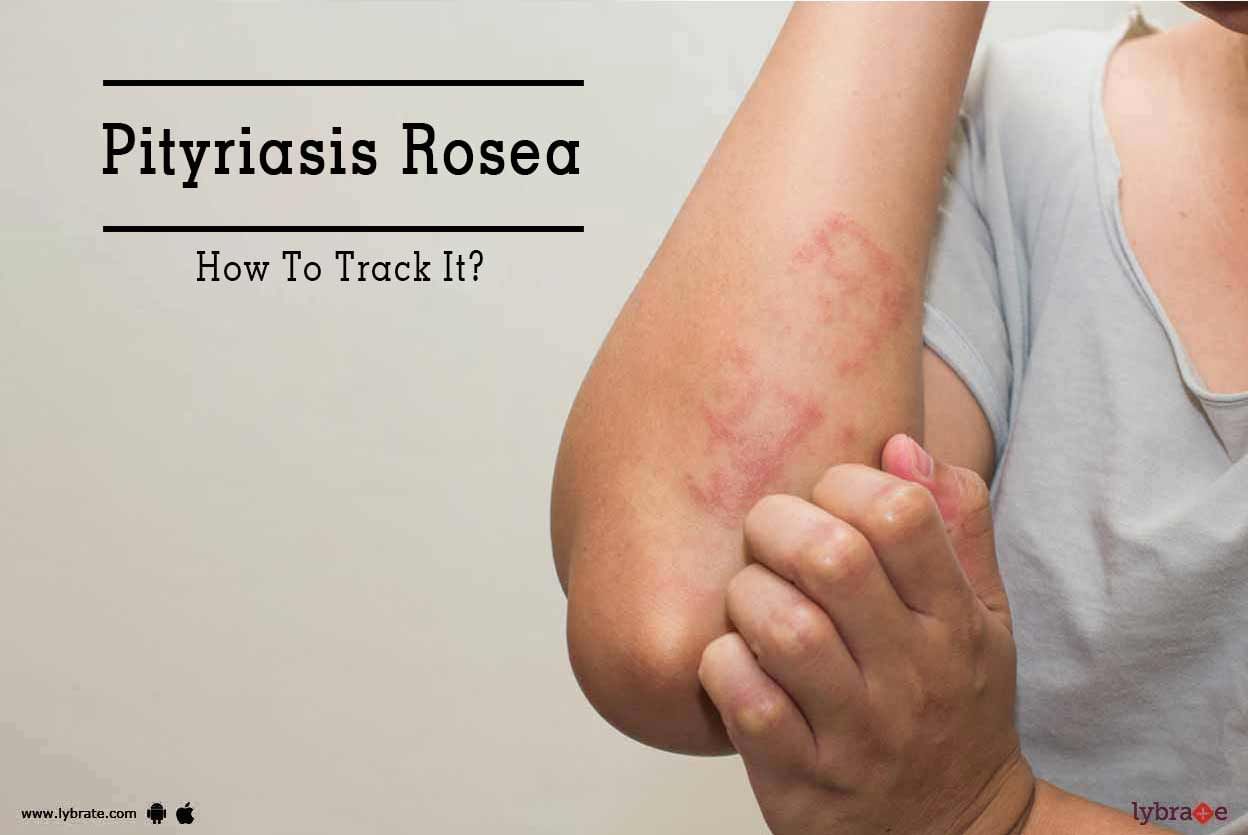 Pityriasis Rosea - How To Track It?