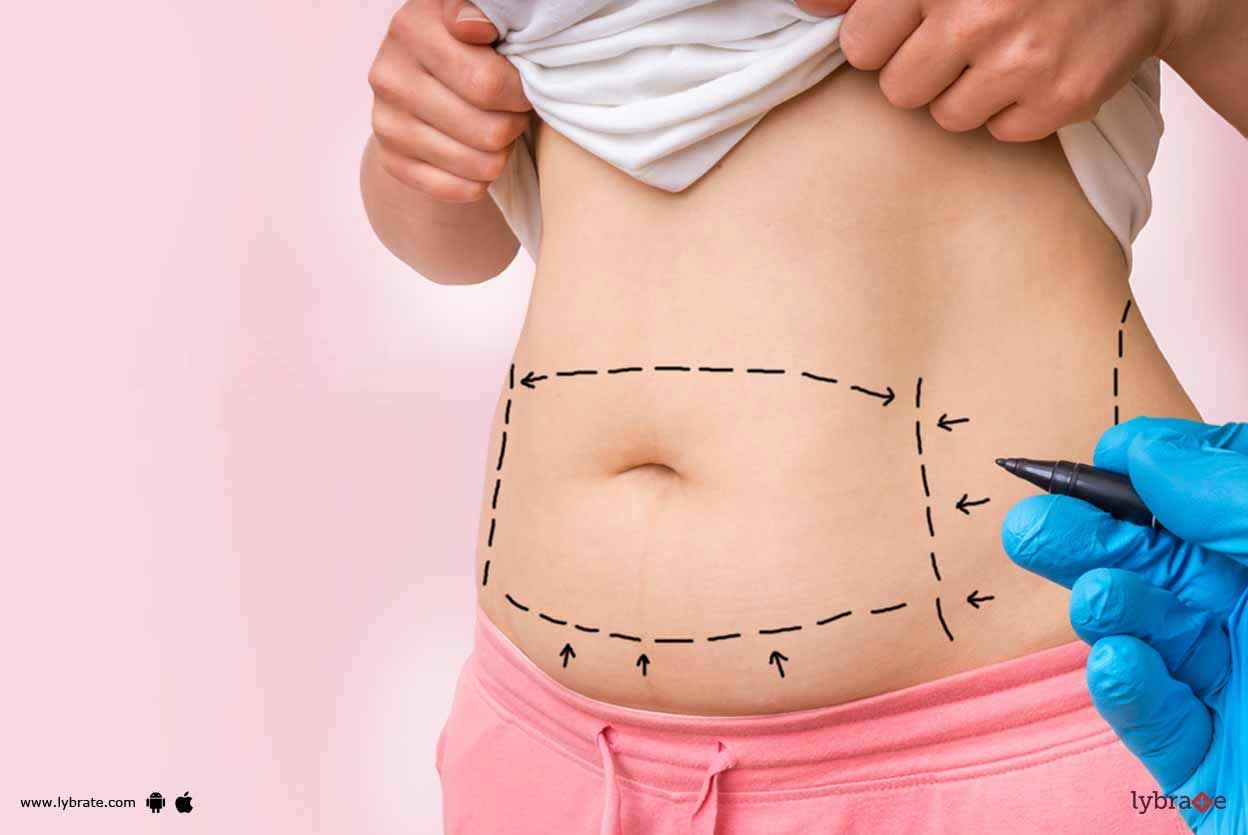 Abdominoplasty - Know Considerations Before It!