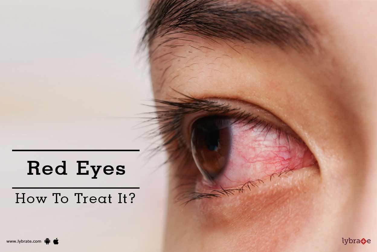 Red Eyes - How To Treat It?
