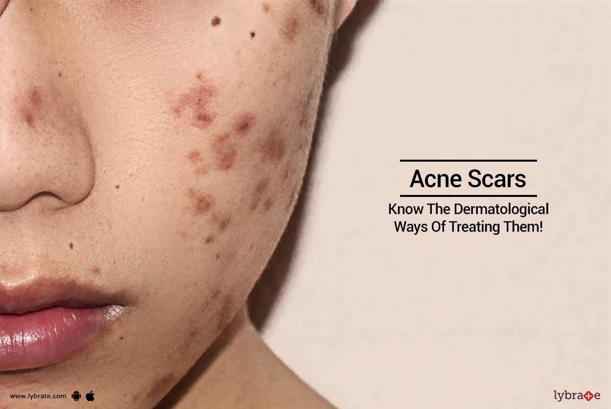 Acne Scars - Know The Dermatological Ways Of Treating Them!