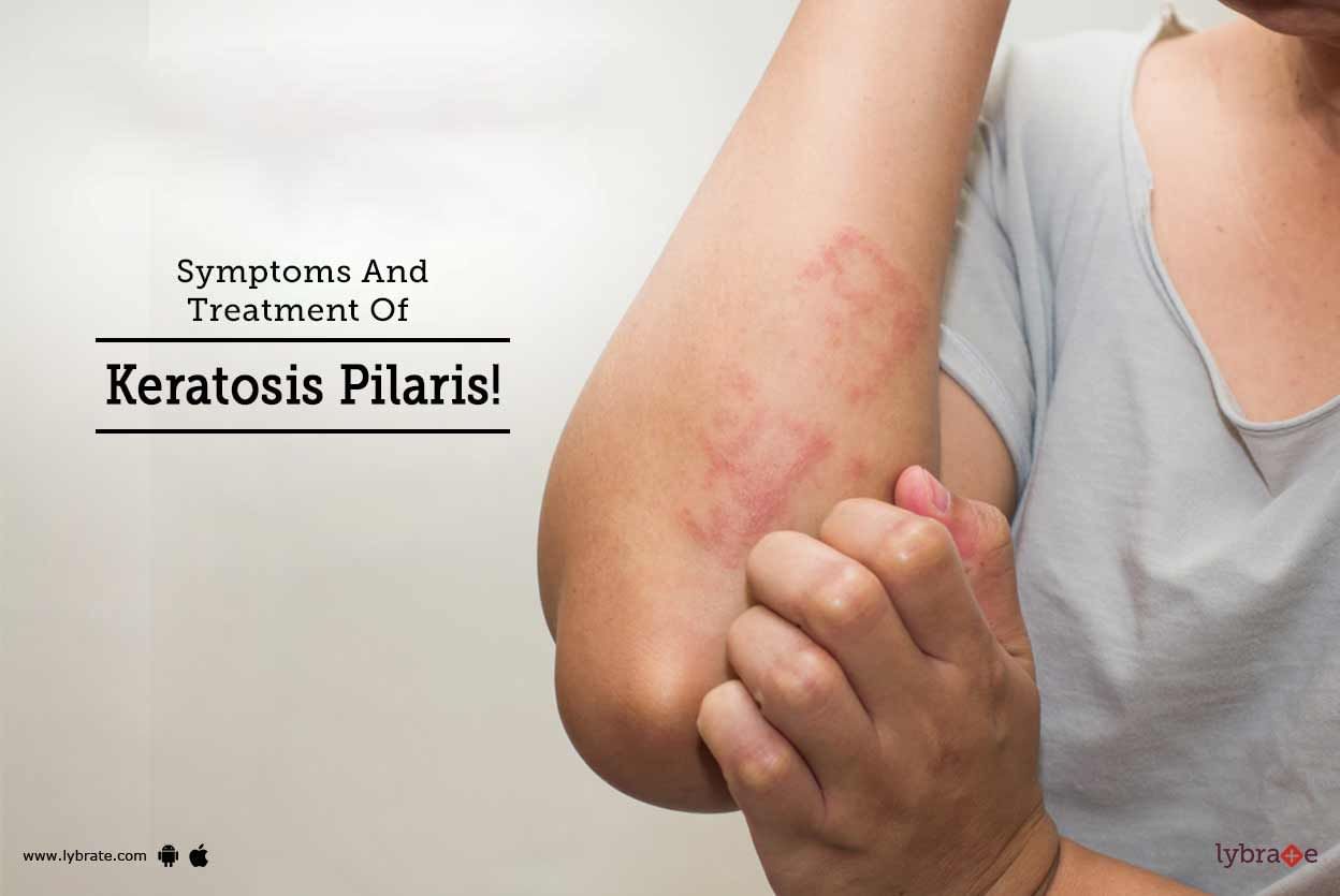 Symptoms And Treatment Of Keratosis Pilaris!