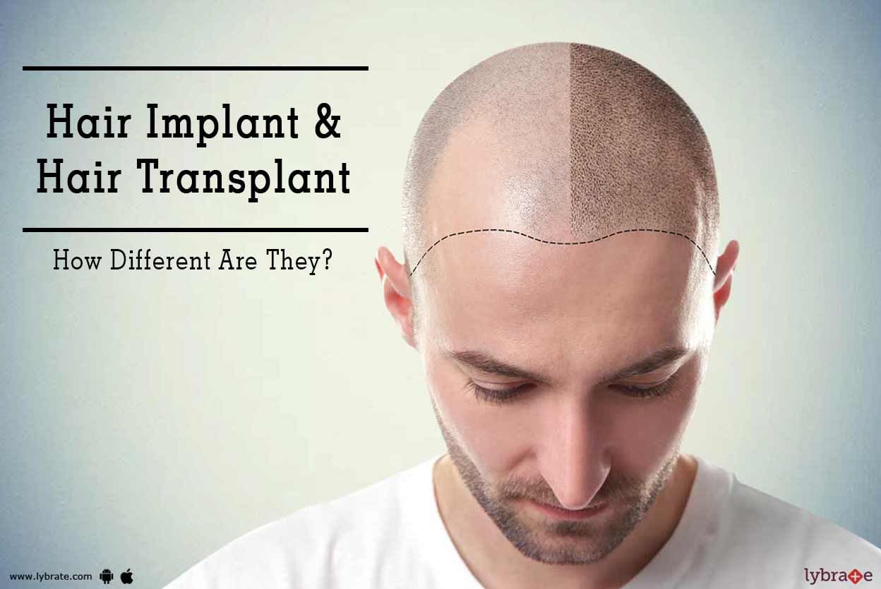 Hair Implant & Hair Transplant - How Different Are They?