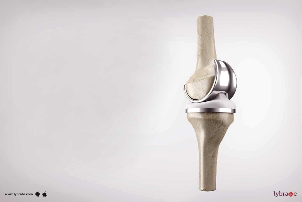 Joint Replacement Surgery - All You Must Know!