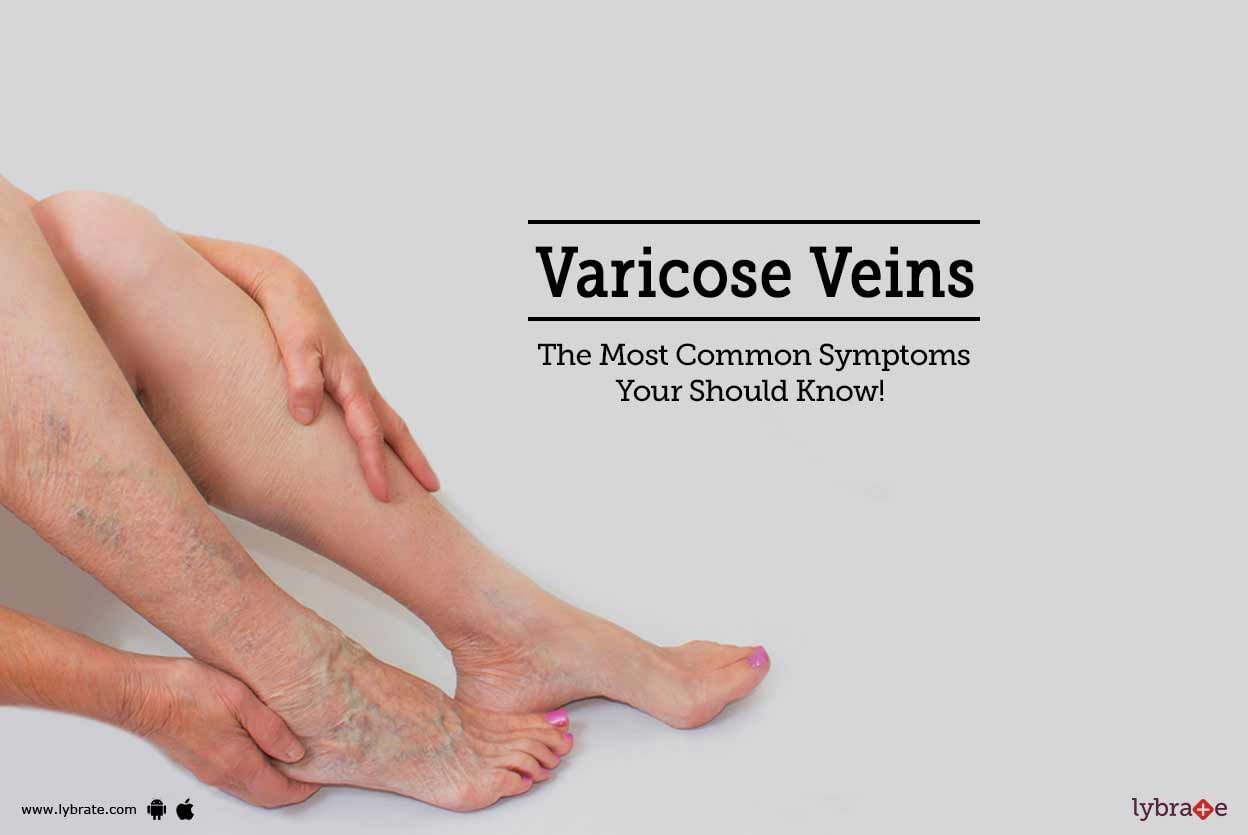 Varicose Veins - The Most Common Symptoms Your Should Know!