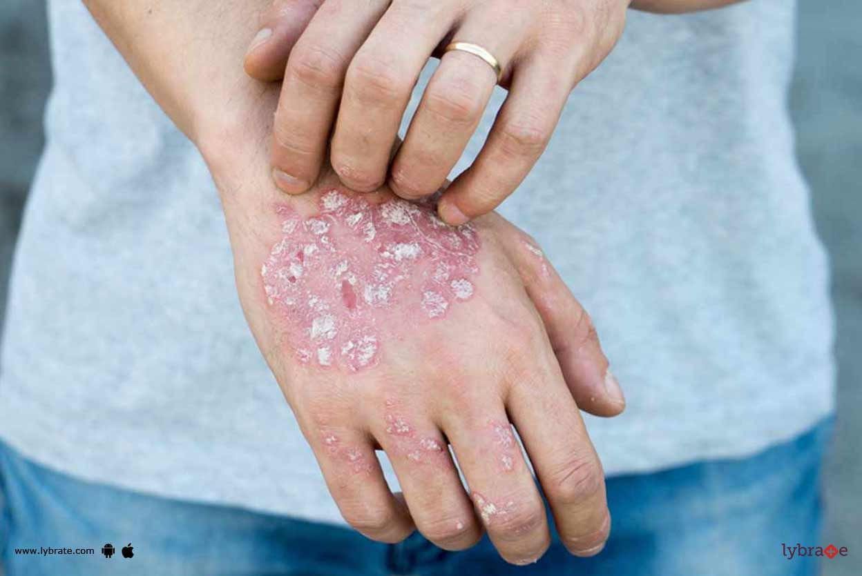 Psoriasis - How Effective Is Homeopathy In It?