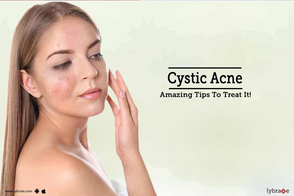 Cystic Acne Amazing Tips To Treat It By Dr Naveen Kumar Boggarapu Lybrate
