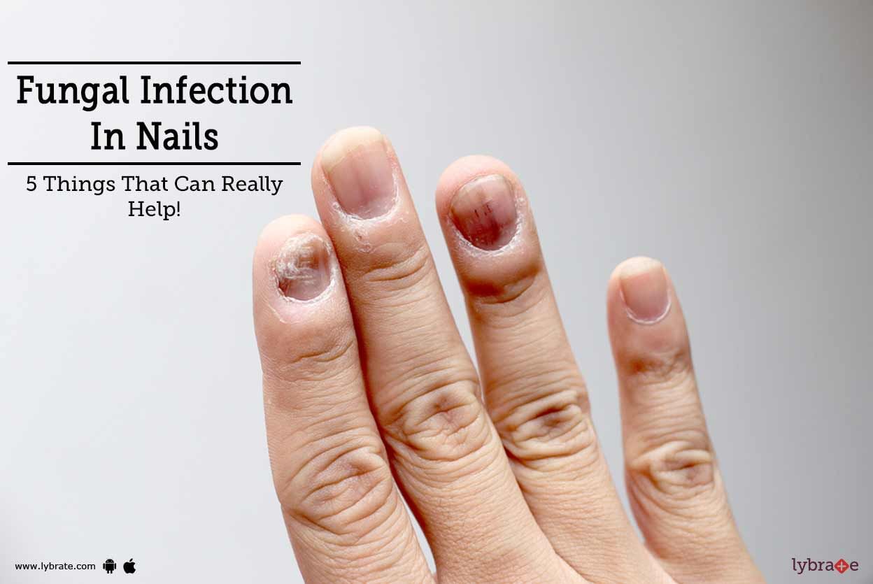 Fungal Infection In Nails - 5 Things That Can Really Help!