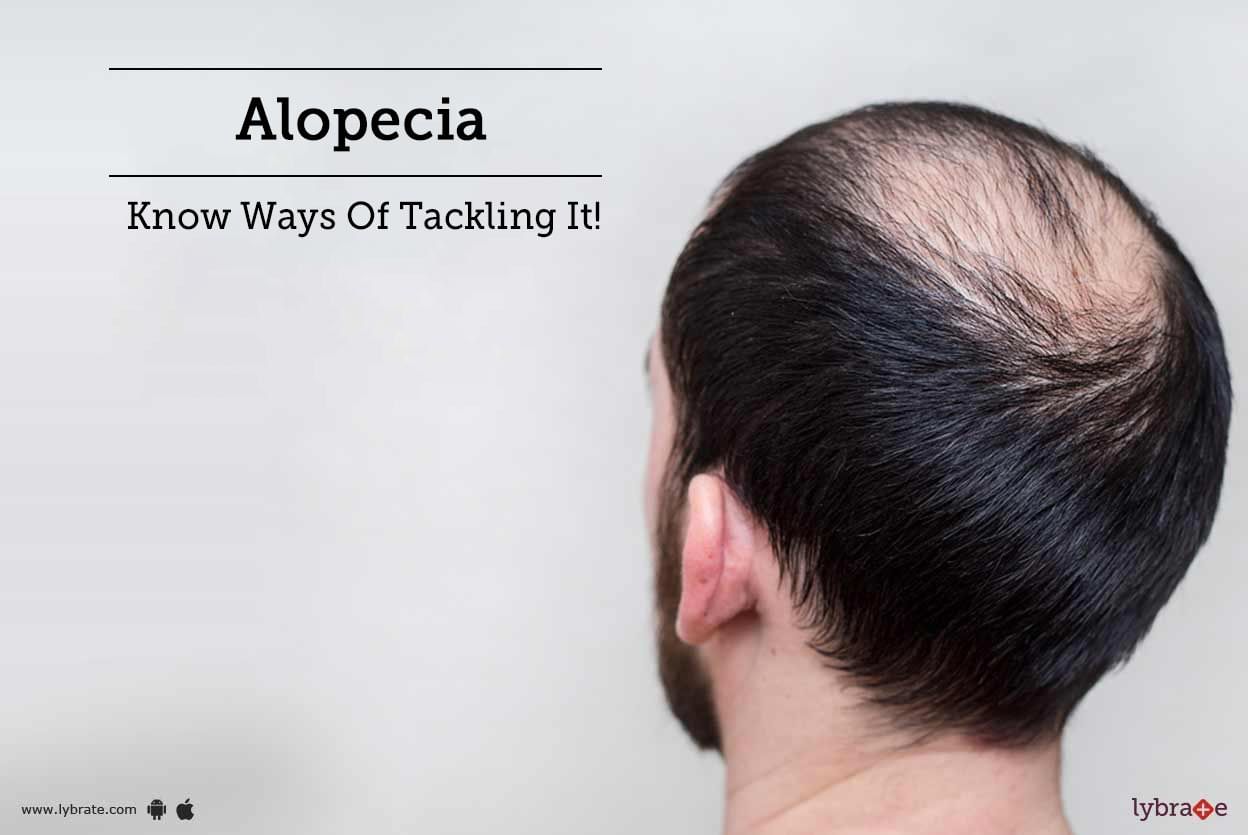 Alopecia - Know Ways Of Tackling It!