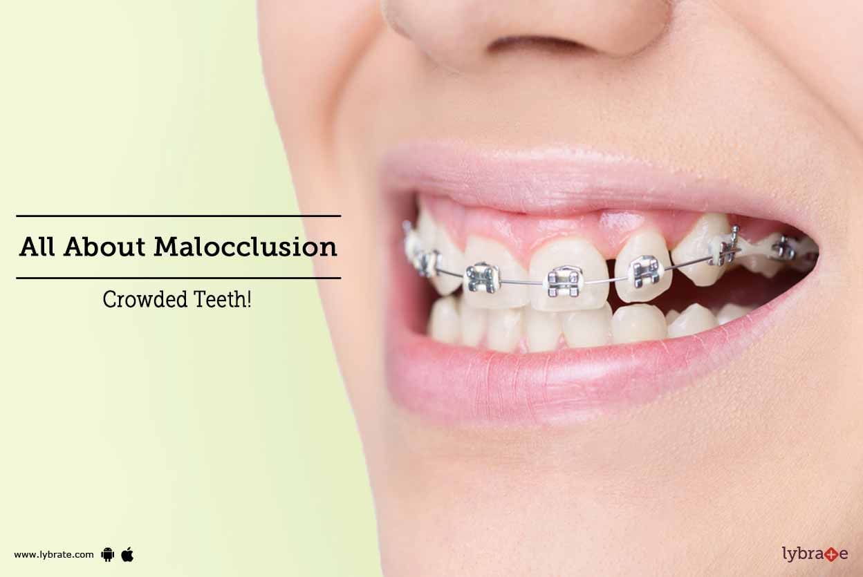 All About Malocclusion - Crowded Teeth!
