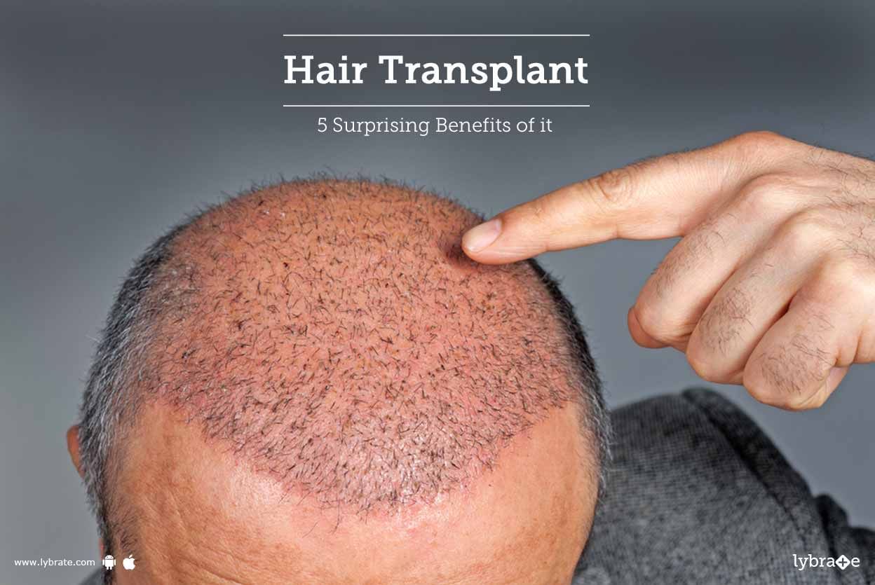 Hair Transplant - 5 Surprising Benefits of it