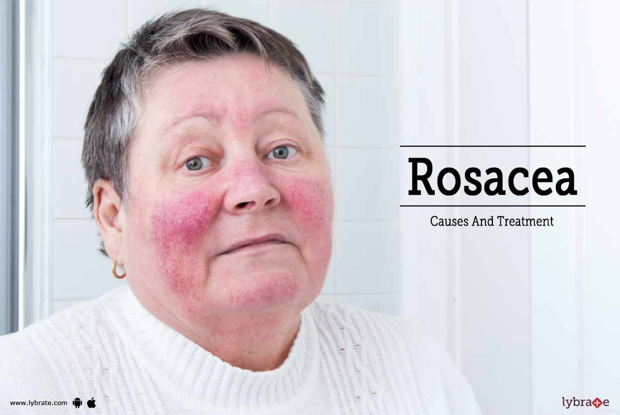 Rosacea - Causes And Treatment