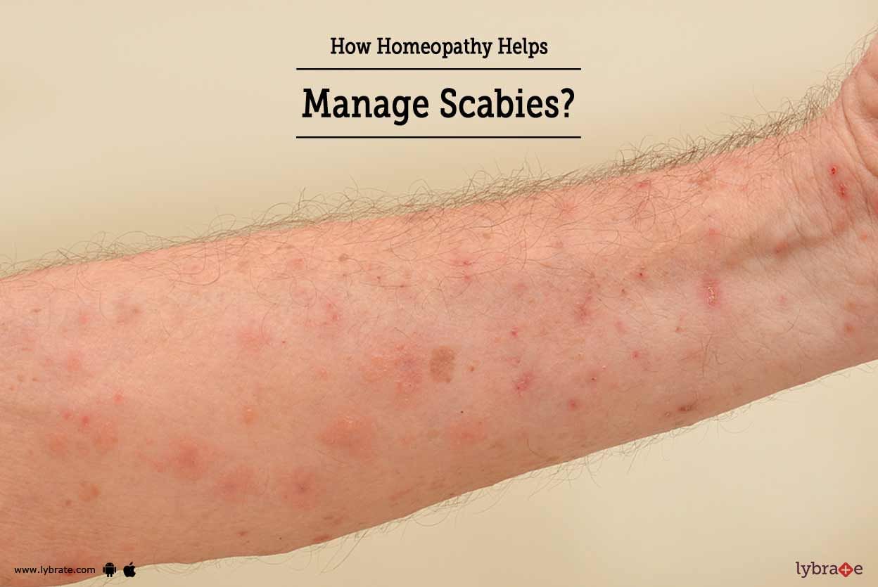 How Homeopathy Helps Manage Scabies?