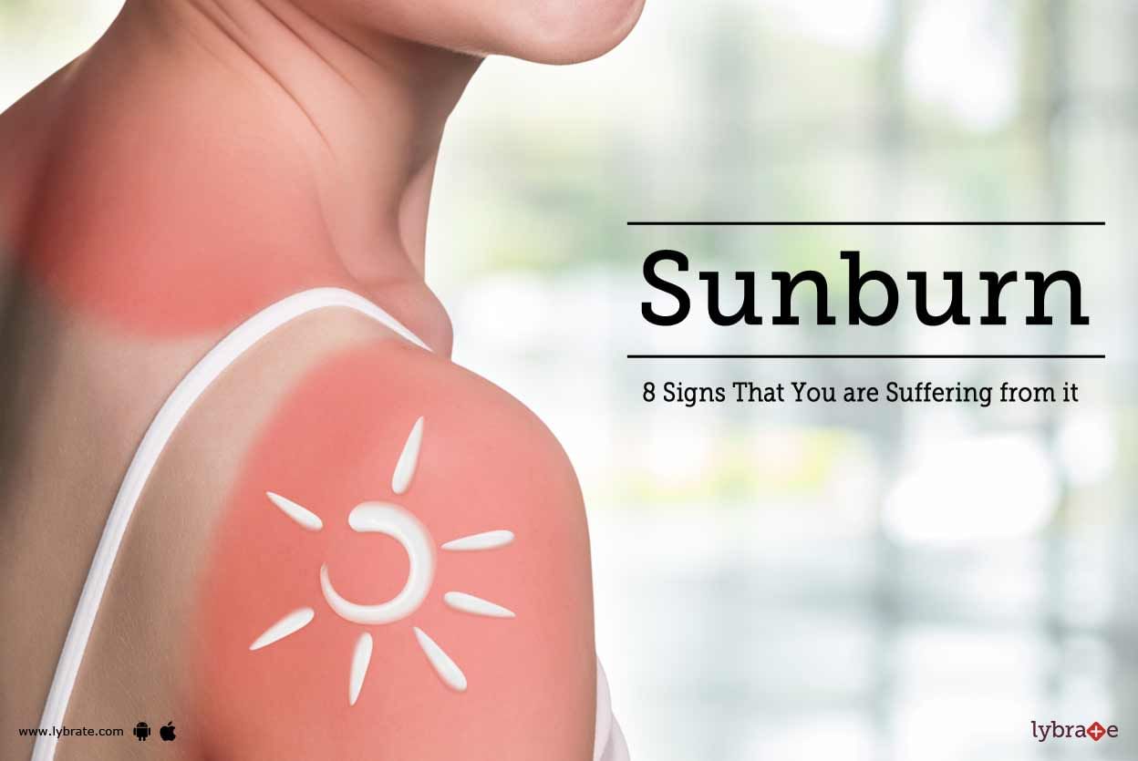 Sunburn - 8 Signs That You are Suffering from it