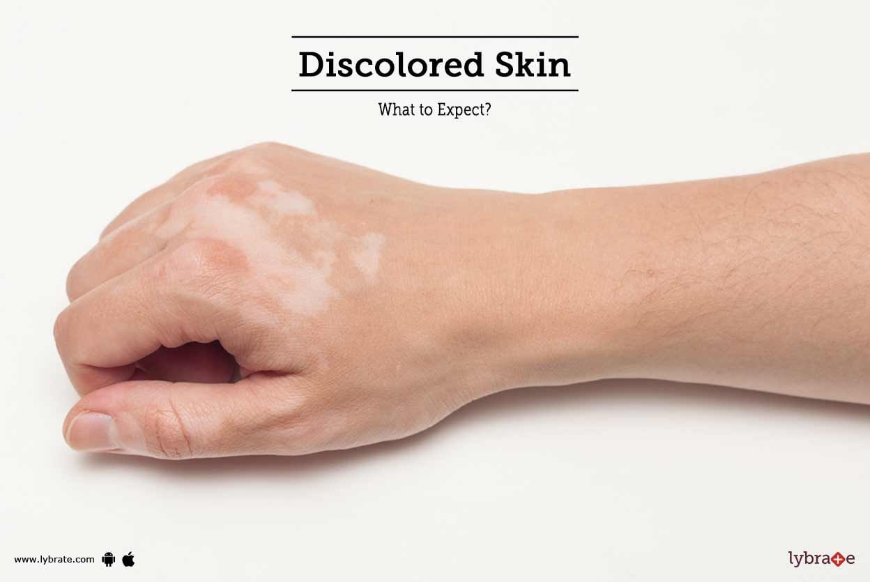 Discolored Skin - What to Expect?