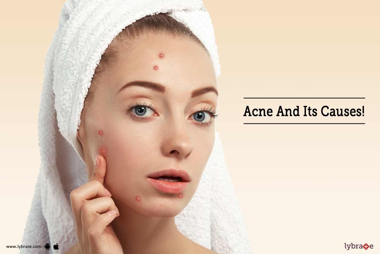 Acne And Its Causes!
