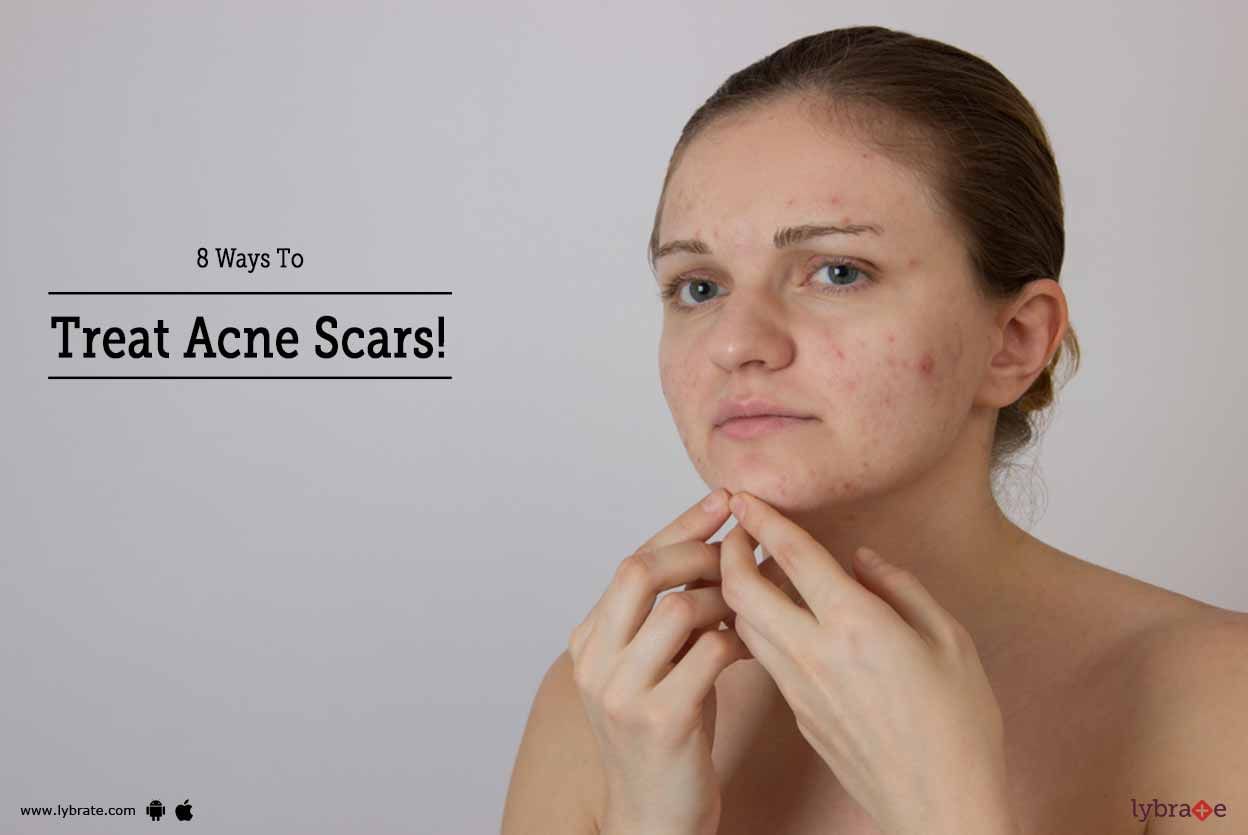 8 Ways To Treat Acne Scars!