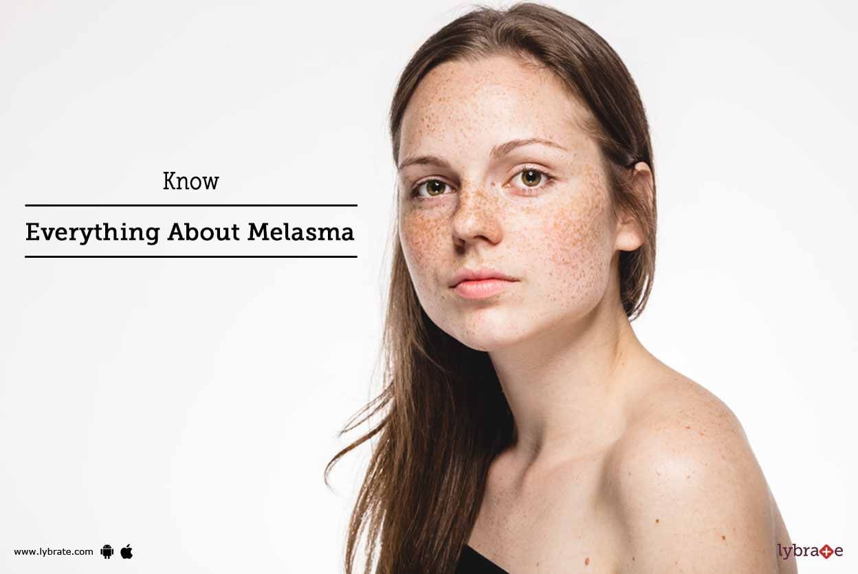 Know Everything About Melasma