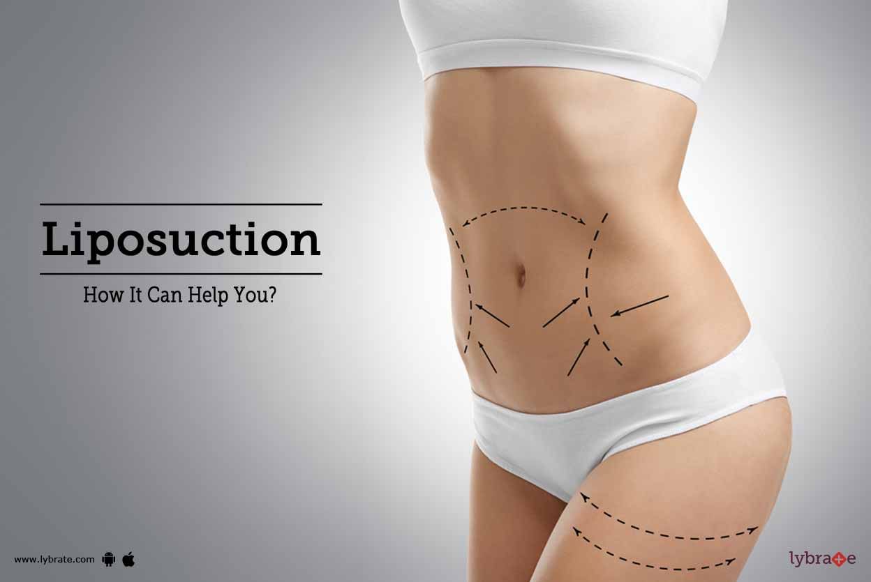 Liposuction - How It Can Help You?