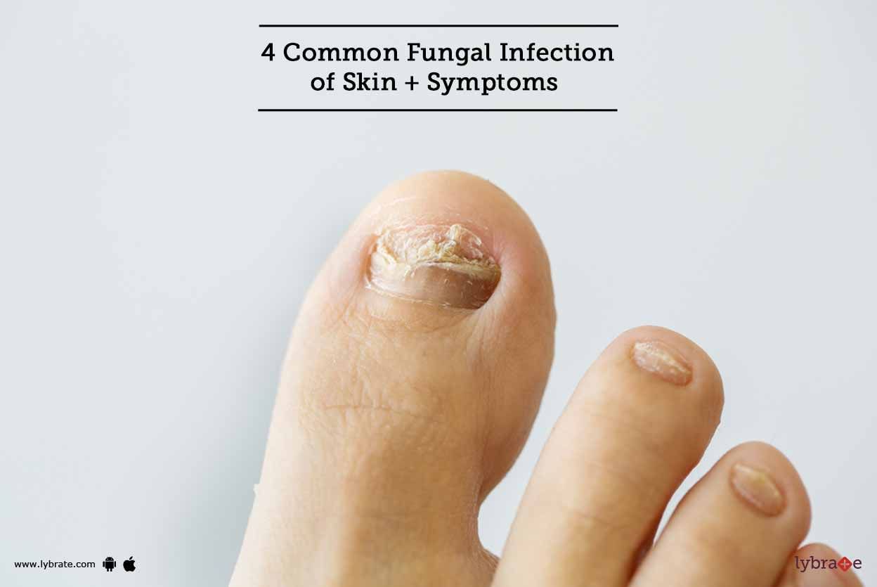 4 Common Fungal Infection of Skin + Symptoms