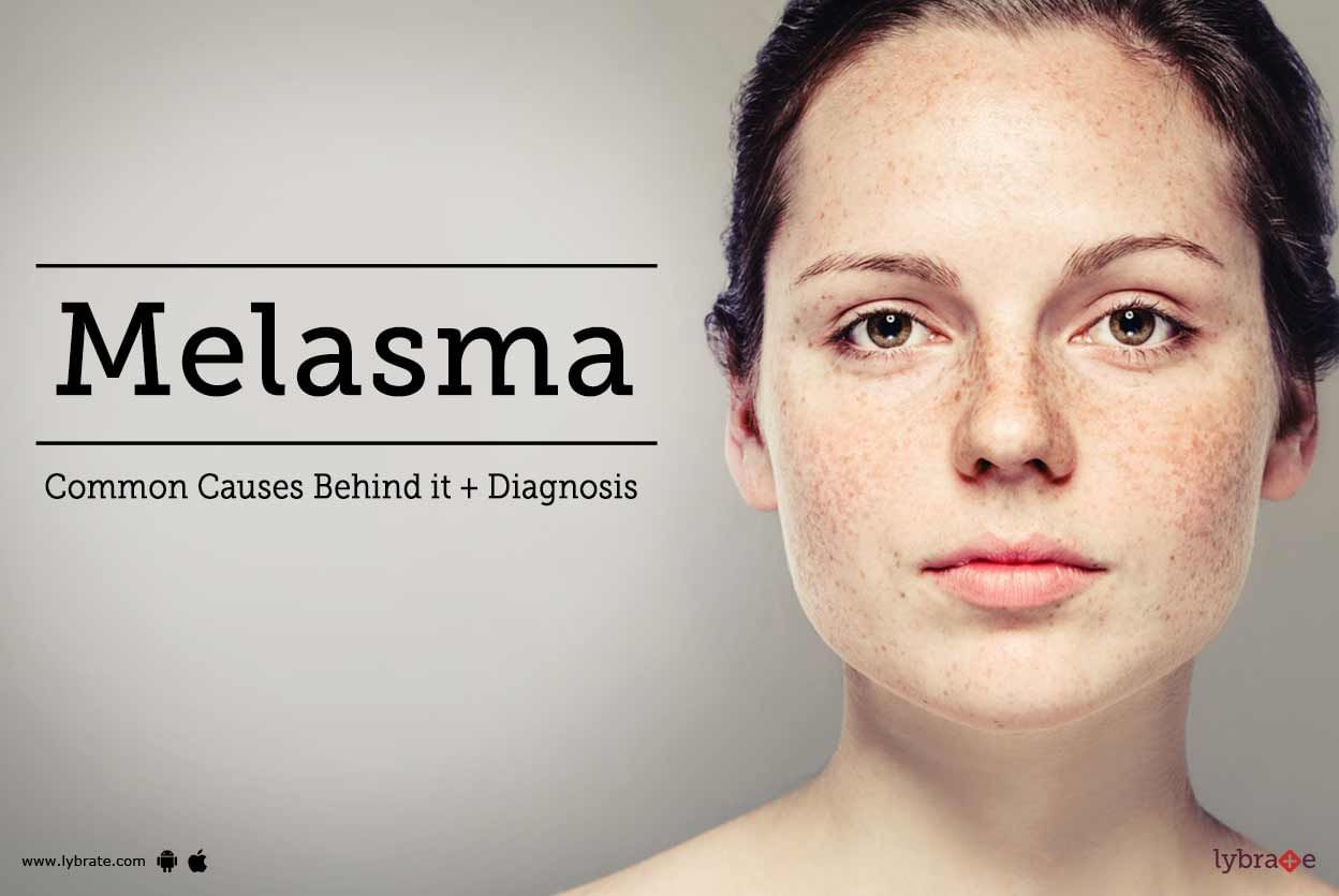 Melasma - Common Causes Behind it + Diagnosis