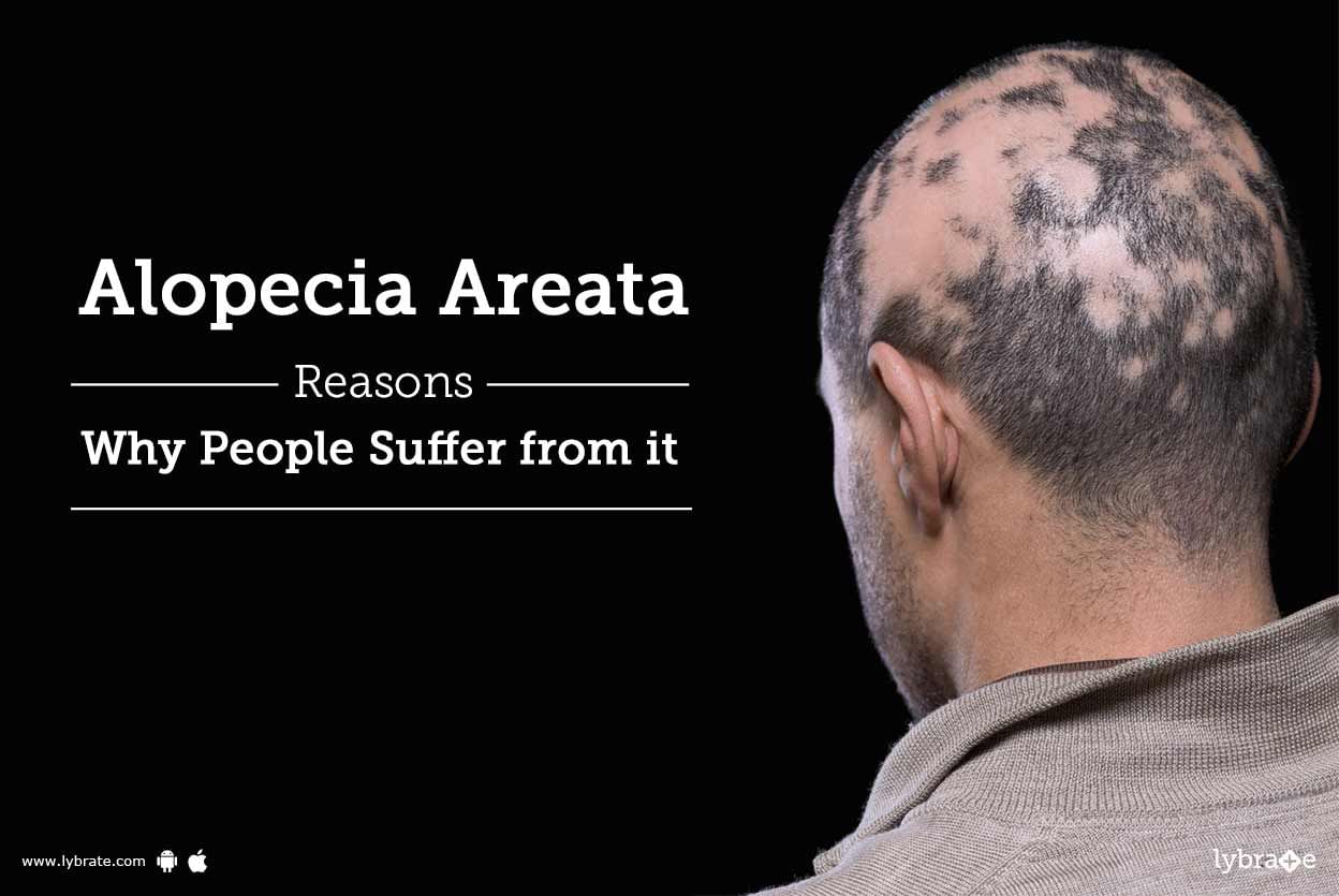 Alopecia Areata - Reasons Why People Suffer from it