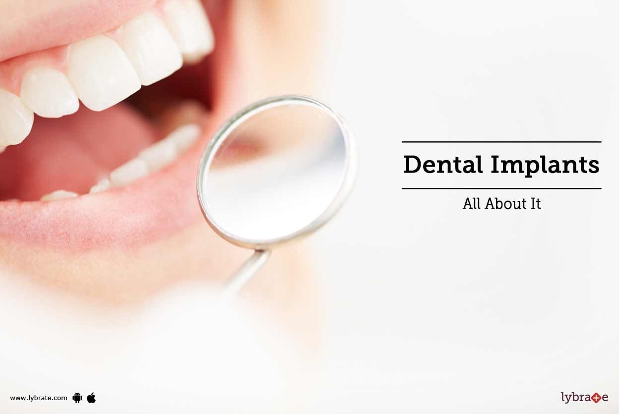 Dental Implants: All About It