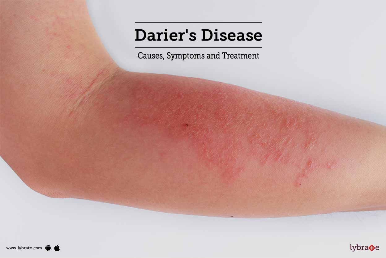 Darier's Disease: Causes, Symptoms and Treatment