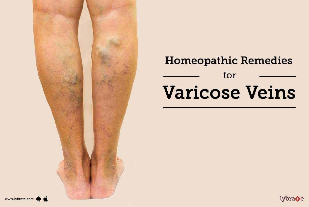 Homeopathic Remedies For Varicose Veins