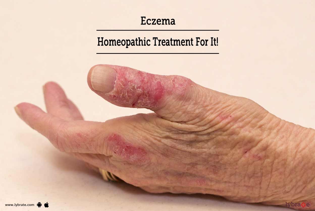 Eczema - Homeopathic Treatment For It!