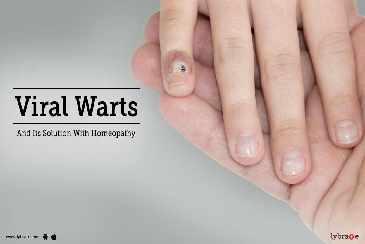 Viral Warts and Its Solution With Homeopathy
