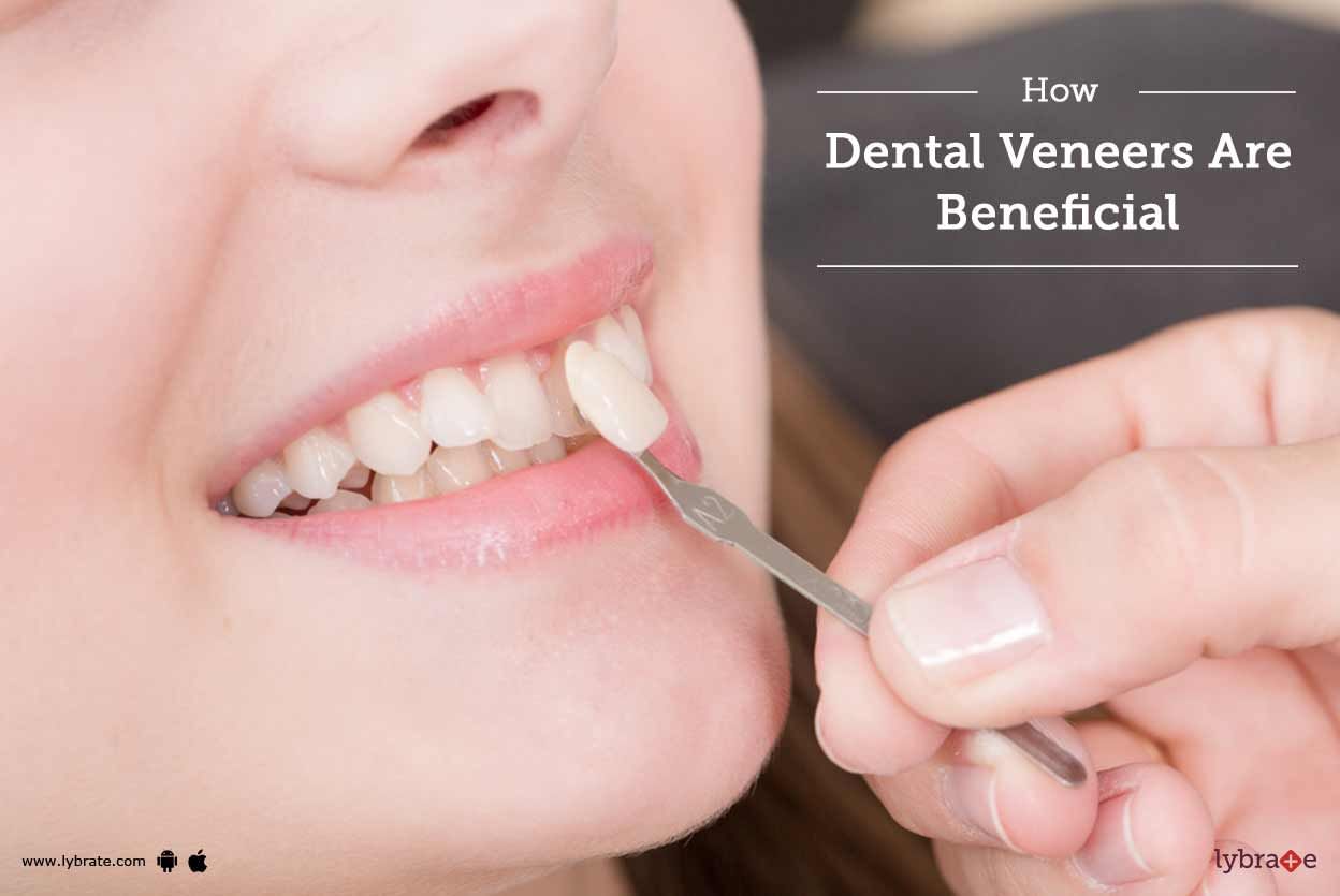 How Dental Veneers Are Beneficial