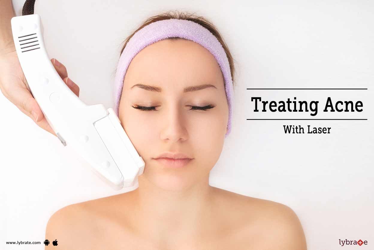 Treating Acne with Laser