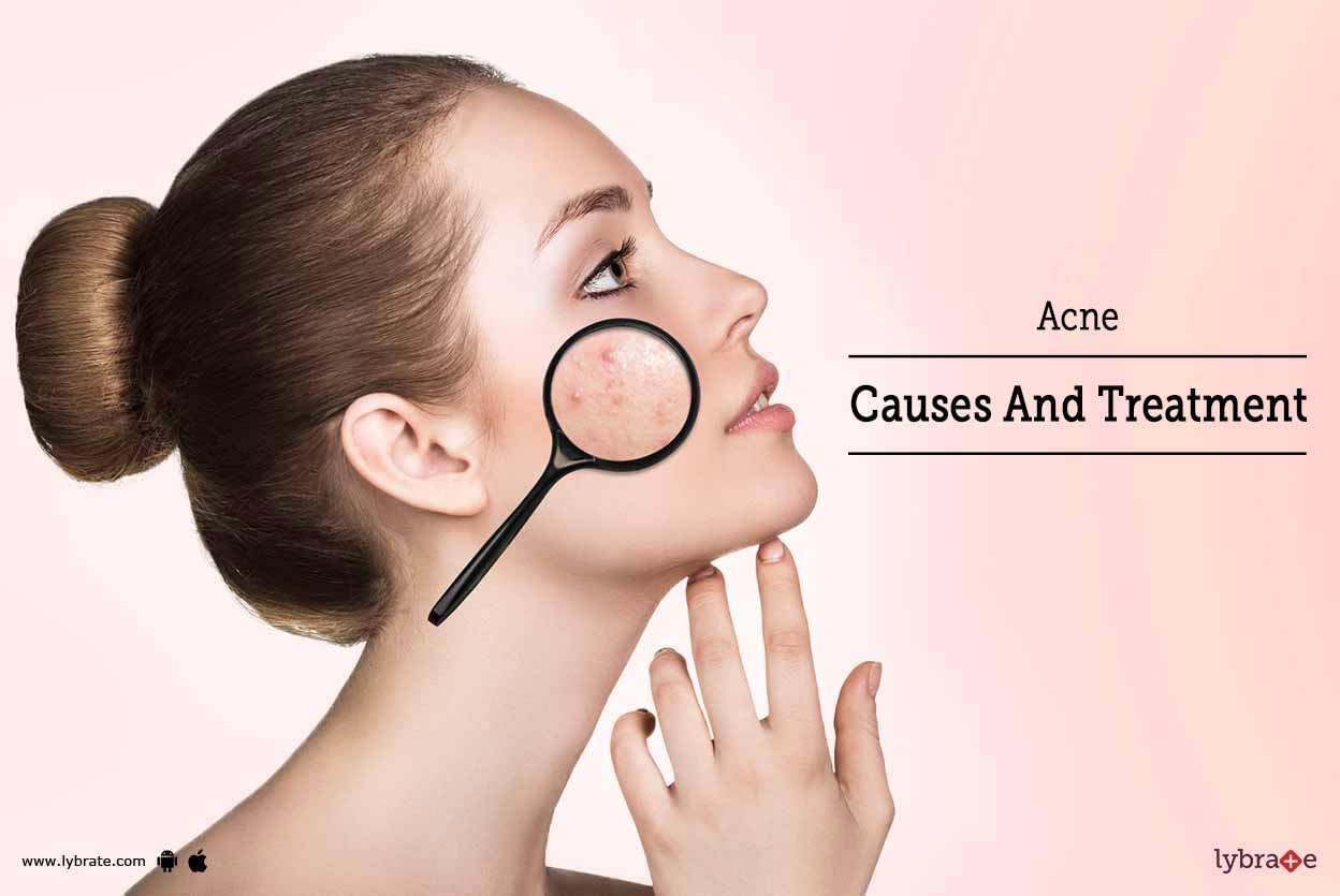 Acne - Causes And Treatment
