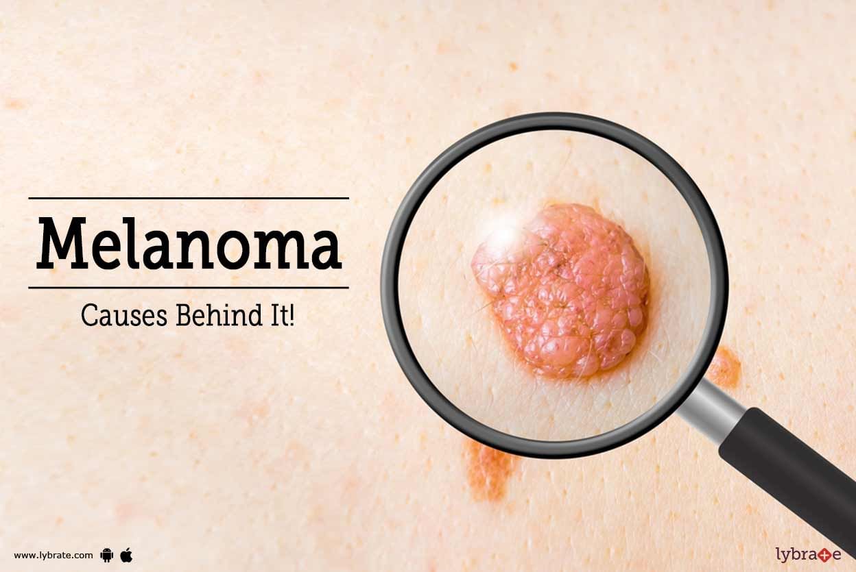 Melanoma - Causes Behind It!