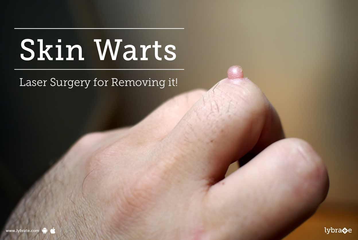Skin Warts - Laser Surgery for Removing it!