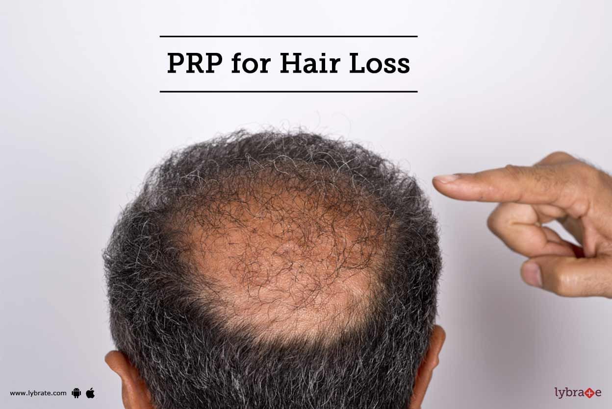 PRP for Hair Loss
