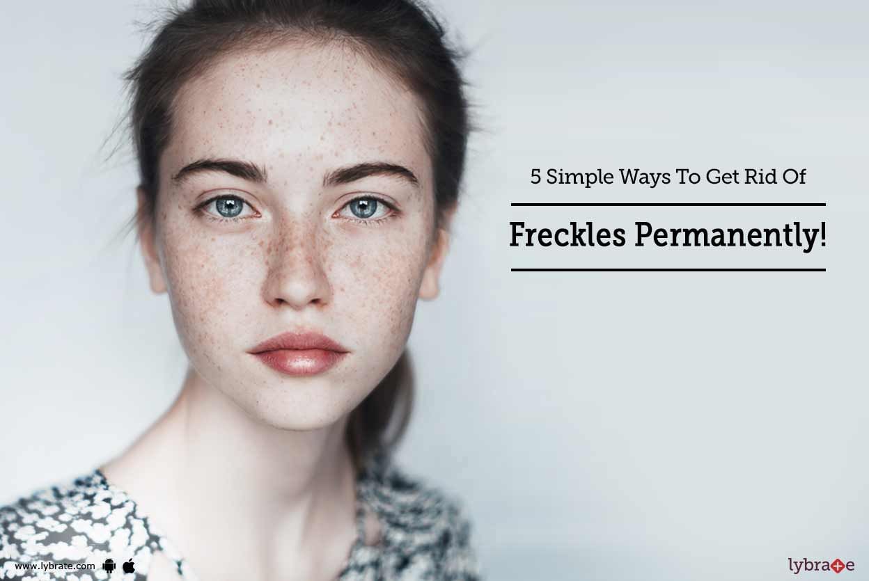 5 Simple Ways To Get Rid Of Freckles Permanently!